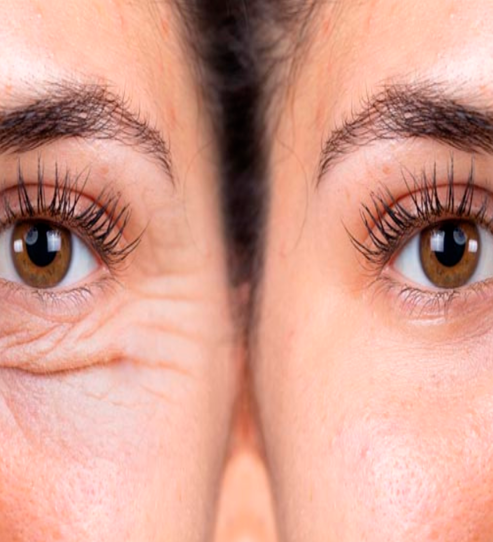 blefaroplastia
