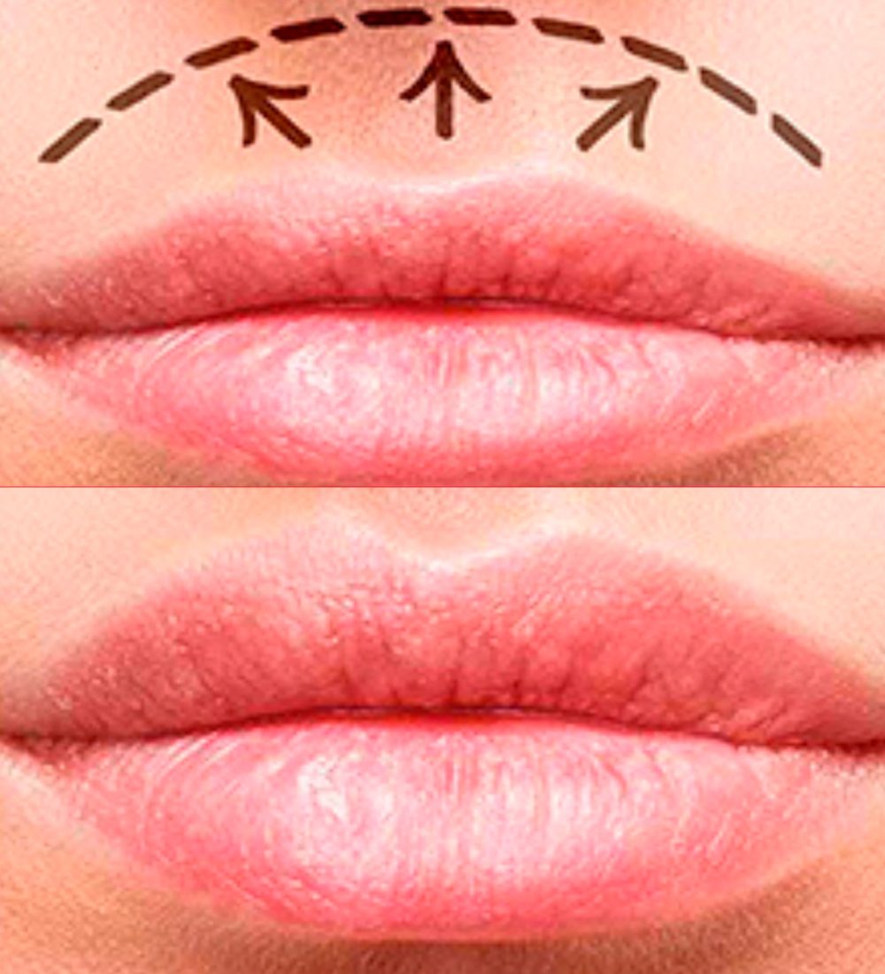 liplifting